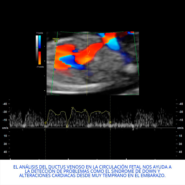 Ductus venoso primer trimestre