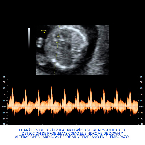 Regurgitación Tricuspidea