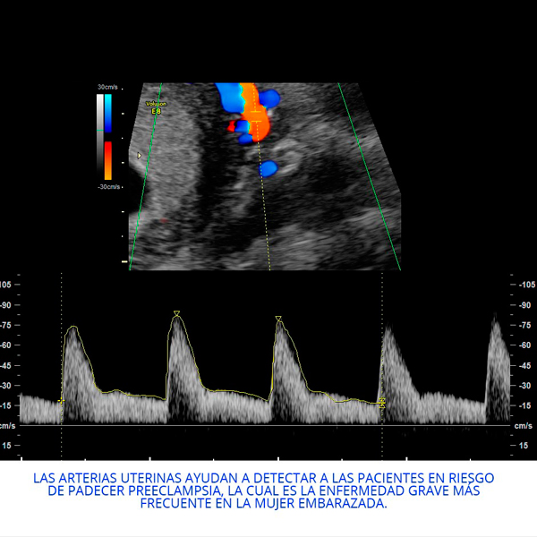 Doppler de arteria uterina